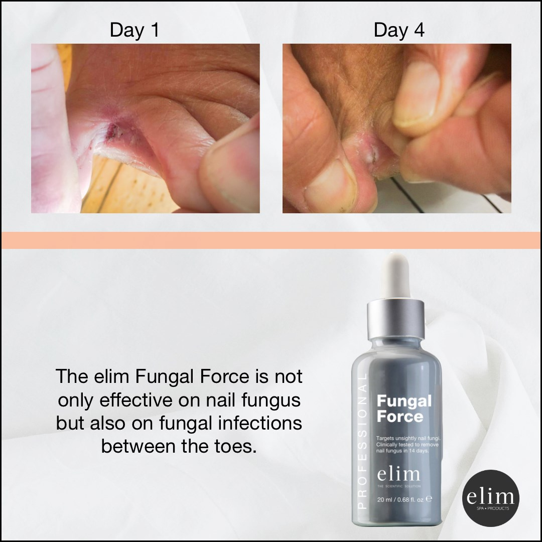 Elim Fungal Force