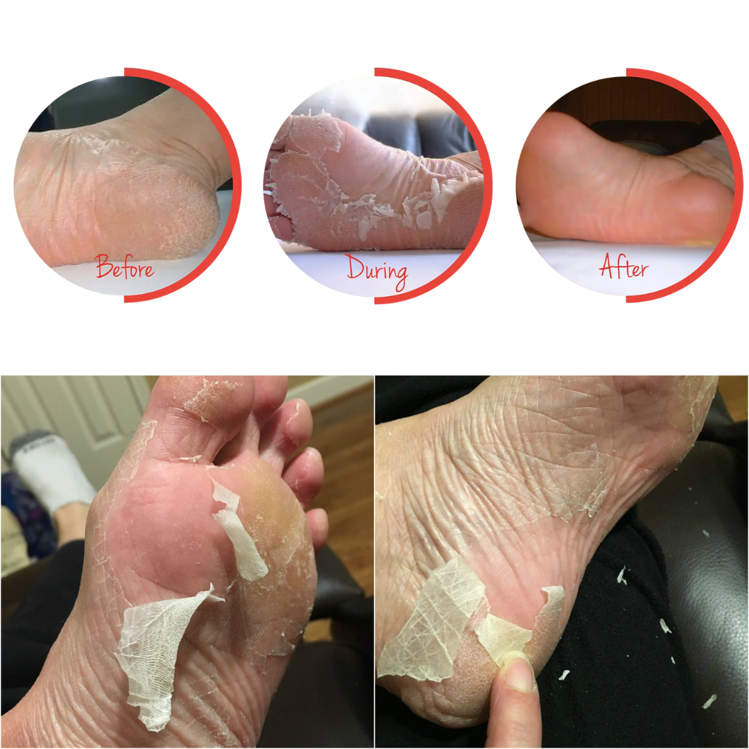 Baby Foot® Original 1hr Foot Peel