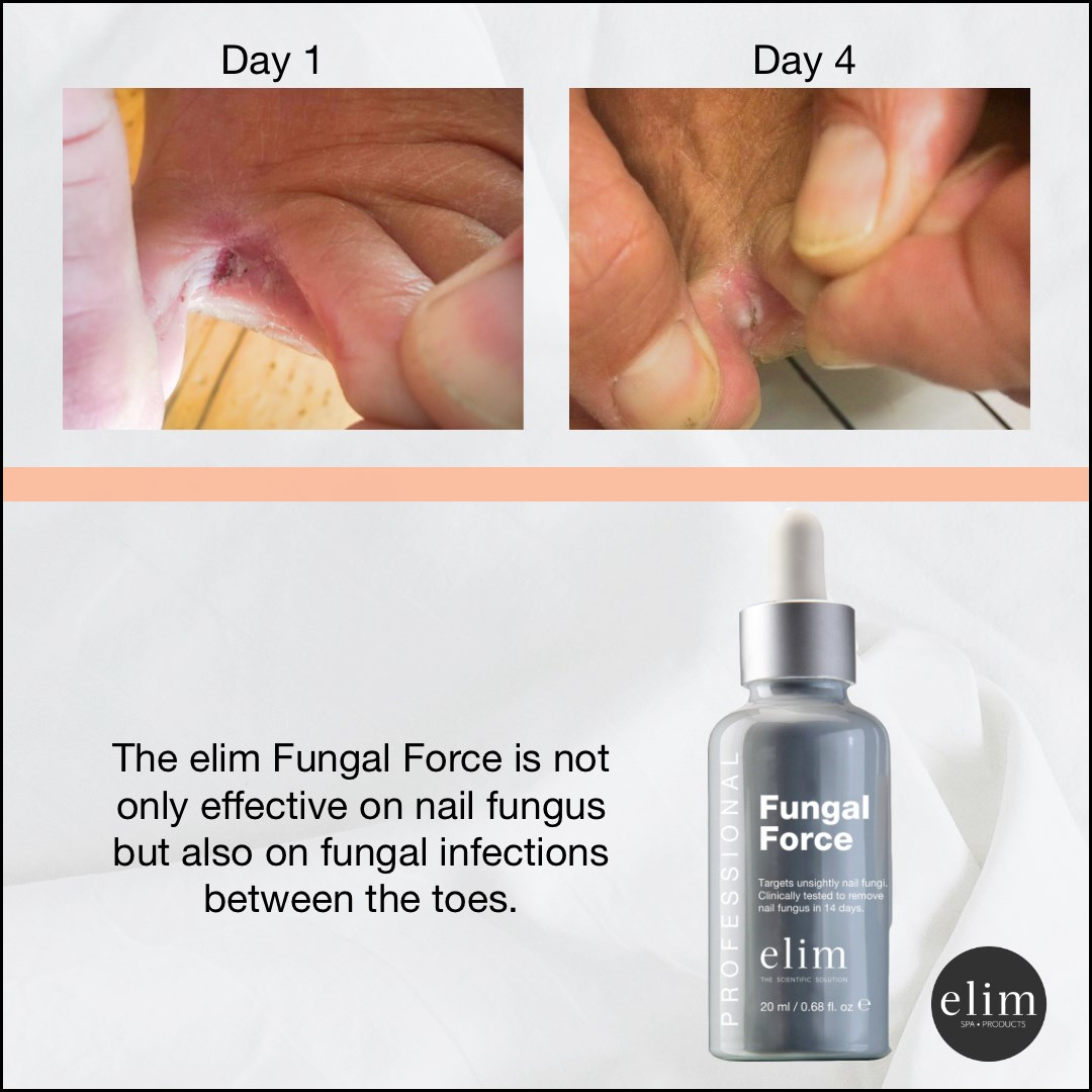 Elim  Fungal Force